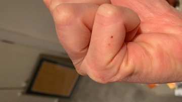 Spider bite Copyright: Julia Brace